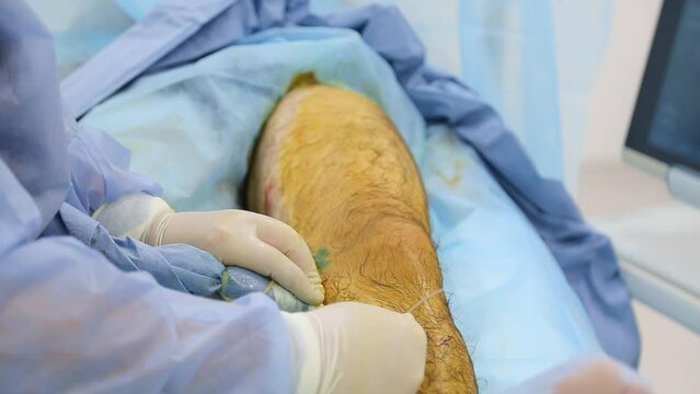 Medical surgery for endovenous laser photocoagulation of the great saphenous vein. Miniphlegectomy. Endovenous laser coagulation vein.