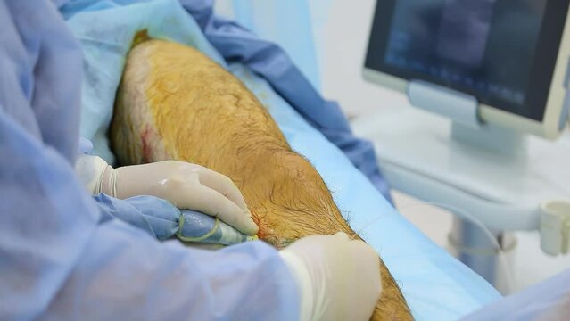 Medical surgery for endovenous laser photocoagulation of the great saphenous vein. Miniphlegectomy. Endovenous laser coagulation vein.