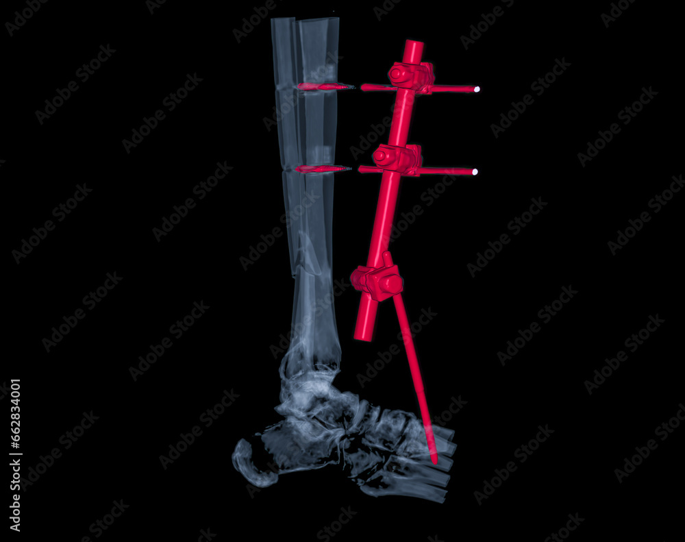 Poster ct scan ankle joint 3d rendering image showing fracture tibia and fibula bone.