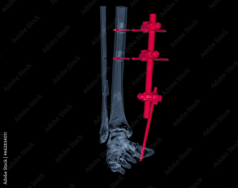 Poster ct scan ankle joint 3d rendering image showing fracture tibia and fibula bone.
