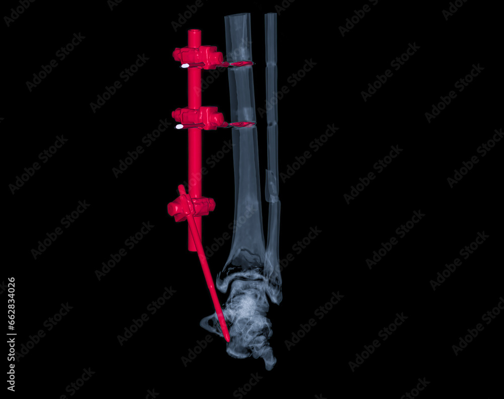 Poster ct scan ankle joint 3d rendering image showing fracture tibia and fibula bone.