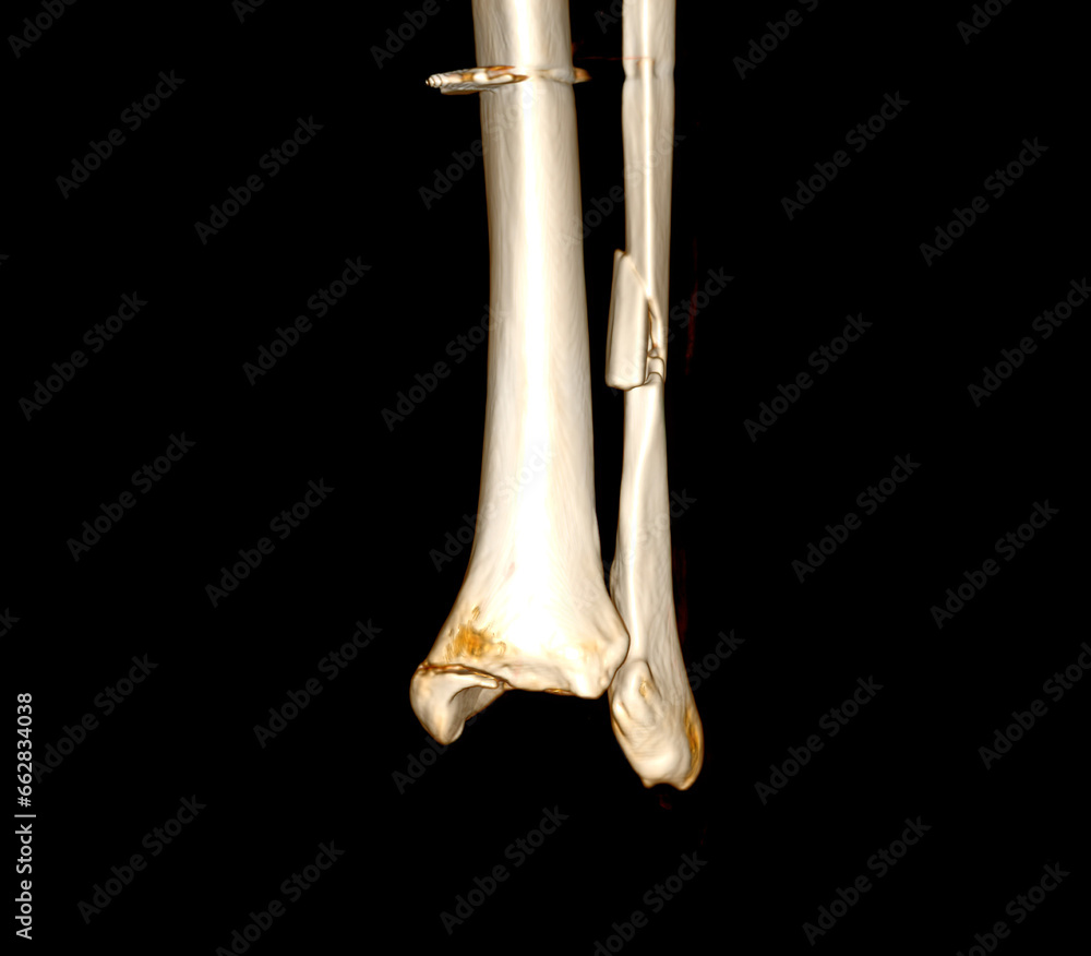 Poster ct scan ankle joint 3d rendering image showing fracture tibia and fibula bone.