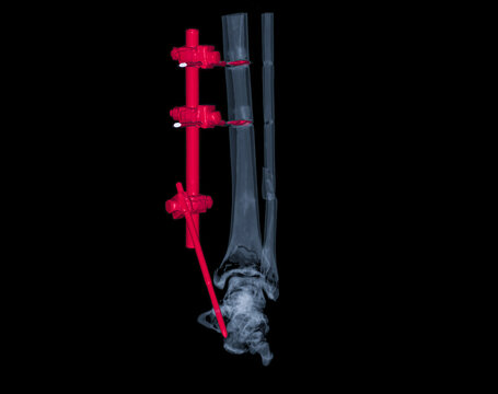 CT Scan ankle joint  3D  Rendering image showing fracture tibia and fibula bone.