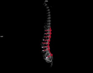  CT scan of thoracic and lumbar spine 3d rendering showing pedicle screw implant after surgical decompression and spinal fusion. - obrazy, fototapety, plakaty