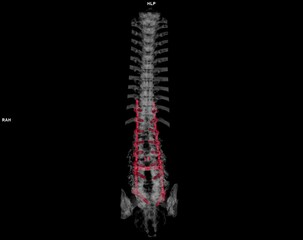  CT scan of thoracic and lumbar spine 3d rendering showing pedicle screw implant after surgical decompression and spinal fusion.