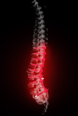  CT scan of thoracic and lumbar spine 3d rendering showing pedicle screw implant after surgical...