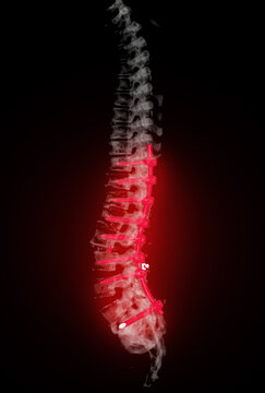  CT scan of thoracic and lumbar spine 3d rendering showing pedicle screw implant after surgical decompression and spinal fusion.