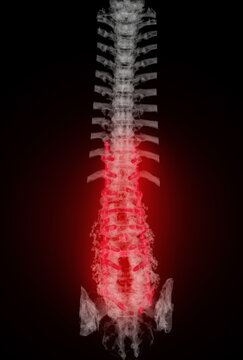  CT scan of thoracic and lumbar spine 3d rendering showing pedicle screw implant after surgical decompression and spinal fusion.