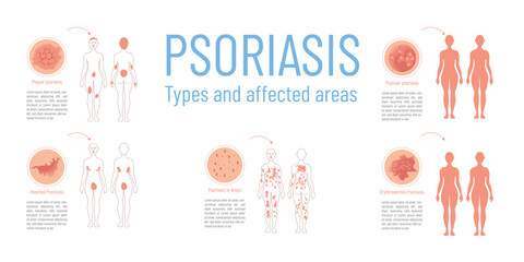 Infographic with graphic representation of the different types of psoriasis and the areas on the body that are affected.
