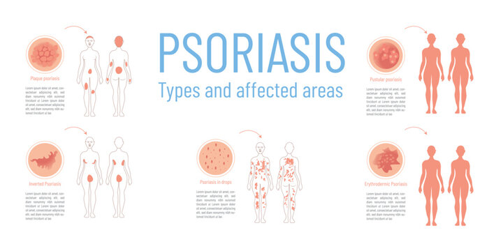 Infographic with graphic representation of the different types of psoriasis and the areas on the body that are affected.