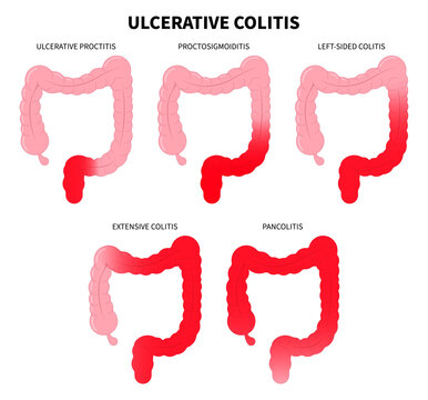 Types of Diarrhea or Ulcerative colitis and Crohn's disease with painful ulcer in bowel