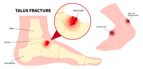 Foot injury with the Talus bone fracture and ankle painful range of motion in medical - obrazy, fototapety, plakaty