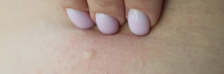 Hand of woman scratches small pimple after insect bite
