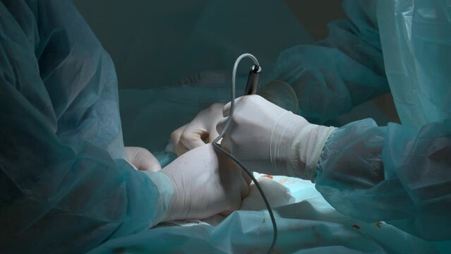 Close up of hands of surgeons team during operation with surgical laparoscopy instruments. Action. Team of surgeons at work in a hospital.