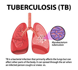 Human Anatomy of Lung with Tuberculosis Infographic