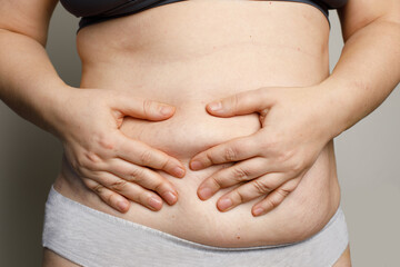Women body with fat belly and stretch mark closeup