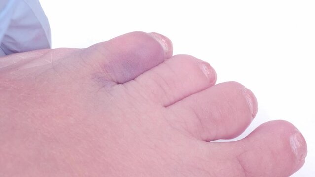 traumatologist examines injured little toe, concept of fracture, bruise, redness in area of injury, soft tissue edema, pain on palpation, industrial or domestic injury