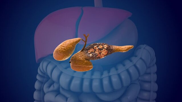 Pancreatic damage and growth of cancer cells