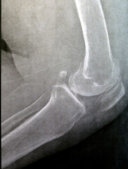 Plain X ray of the left knee shows apparent joint osteoarthritis according to Kellgren and Lawrence...