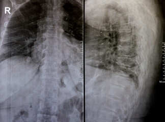 Plain x ray of dorsal and lumber spine reveals spondylotic changes, straightening of dorsal and...