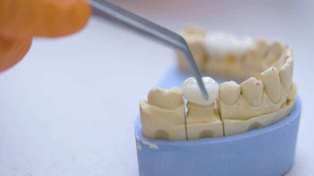 Placement of a dental crown on a jaw model. The doctor puts an artificial tooth, prosthetics close-up
