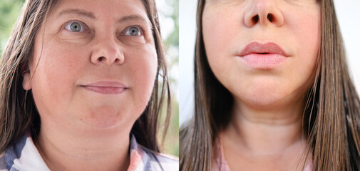 close-up part of female face of woman 40-50 years old with age wrinkles, facial wrinkles before and after treatment, concept of cosmetics, lip augmentation, correction surgery, cosmetic procedures