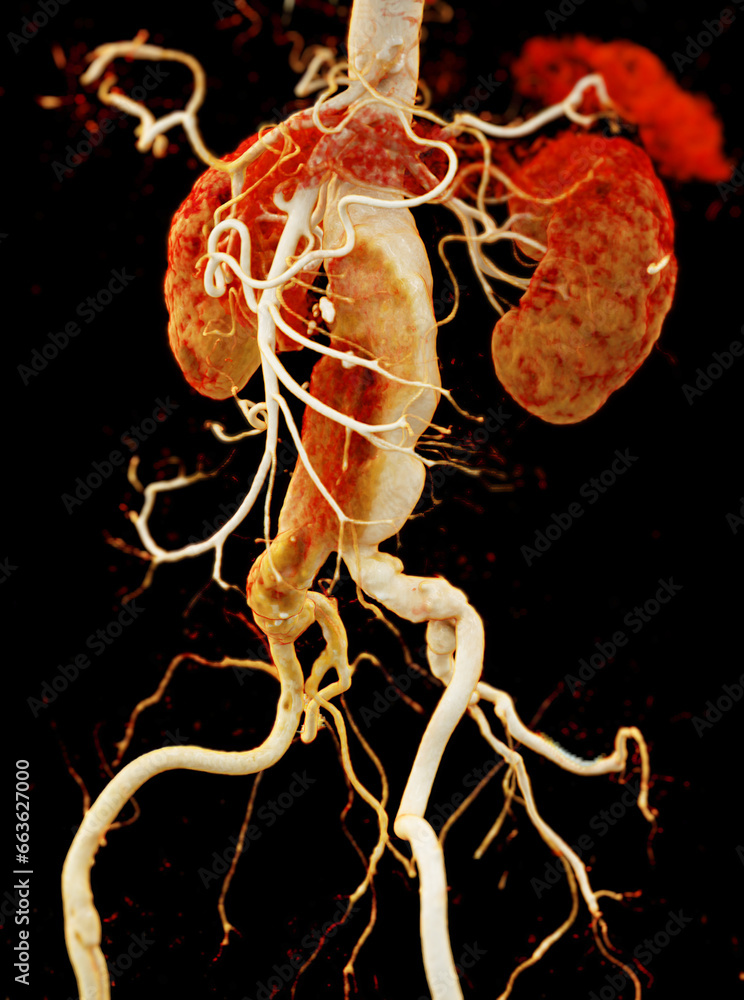 Poster cta abdominal aorta showing abdomenal aortic dissection 3d rendering.