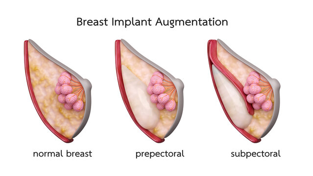 Breast implant augmentation or breast surgery, insert silicone gel with prepectoral and subpectoral technique, isolated white background, 3D rendering.