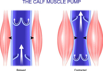 Calf muscle pump. Venous Health.