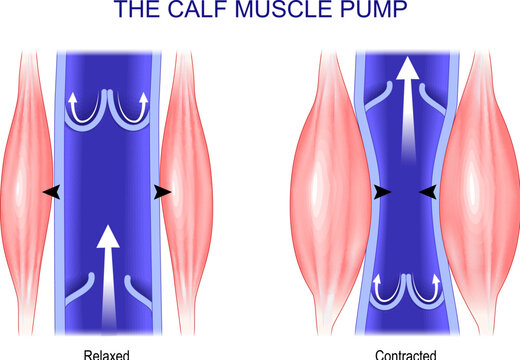 Calf muscle pump. Venous Health.
