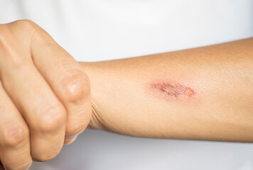 Close-up of a person who received a thermal injury on their skin.
