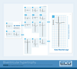 When the QRS wave in the V2-V4 chest lead is biphasic and has an amplitude exceeding 60mm, it is necessary to be vigilant about the electrocardiogram of biventricular hypertrophy.