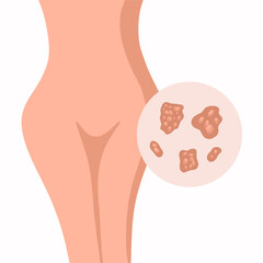 Vector isolated illustration of genital herpes in women. Rash of genital herpes. - obrazy, fototapety, plakaty