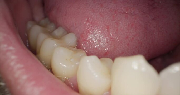 Untersuchung untere Zahnreihe beim Zahnarzt