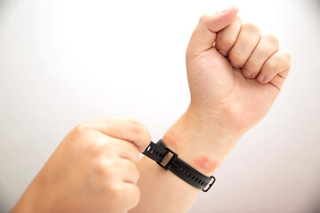 A man tightens a fitness bracelet with a silicone strap on his wrist, close-up. Concept of allergy and skin irritation from silicone watch strap, dermatitis. Copy space for text
