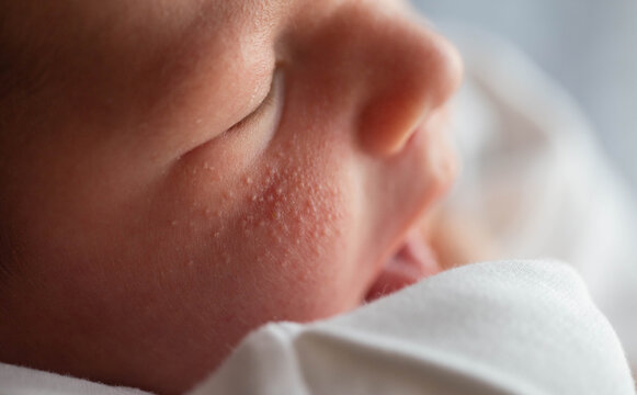 Pimples on the face of a newborn. Baby's adaptation to the environment, close-up