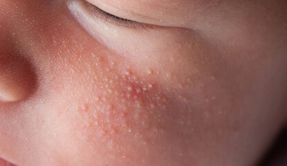 Allergic pimples in a newborn on the face. Pathogenesis, acne of newborns. - obrazy, fototapety, plakaty