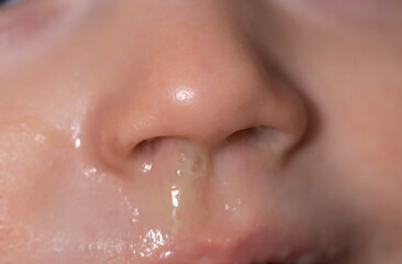 Close-up of a small child's face and nose with snot. The concept of colds, rhinitis and runny nose in children.