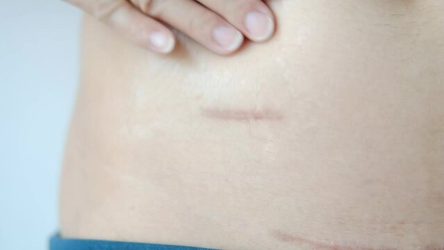 Using cream to care for scars after appendix surgery