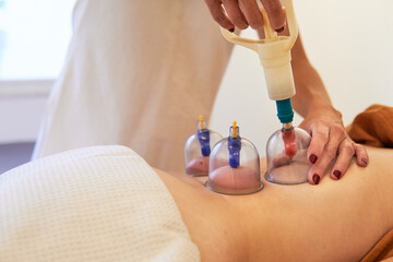 Practitioner performing vacuum cupping therapy with pumping gun on the back of a woman - obrazy, fototapety, plakaty