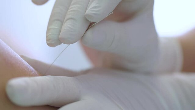 Medical Procedure Acupuncture . Close-up of a man being treated with acupuncture at a clinic