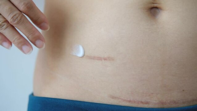 Slow motion using cream to care for scars after appendix surgery