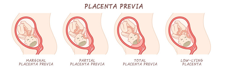 前置胎盤、placenta previa、illustration - obrazy, fototapety, plakaty