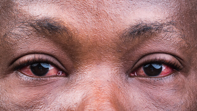 Eyes section of a face showing infectious, unhealthy, and abnormal redness of the eye which is caused by a communicable disease called conjunctivitis health condition, also known as Apollo in Nigeria,