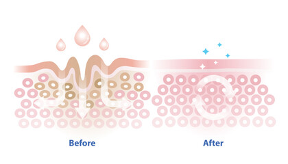 Before and after skincare absorption vector illustration isolated on white background. Cross section of wrinkles skin and skincare absorbing to help reduce aging and damaged skin. Skin care concept. - obrazy, fototapety, plakaty