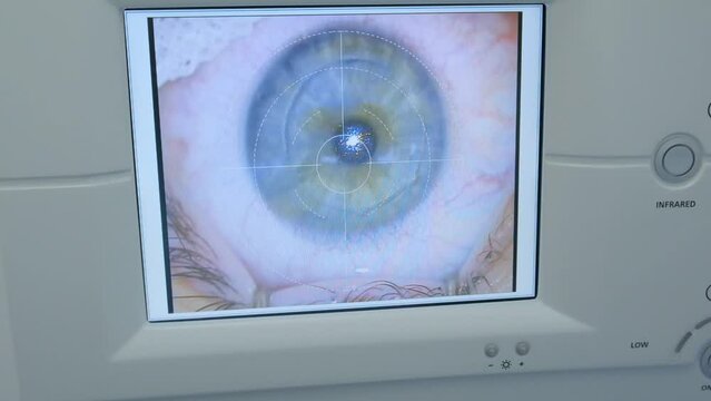 An imaging system showing a clear image of the cornea during surgery. View of the monitor, femtosecond laser operation.