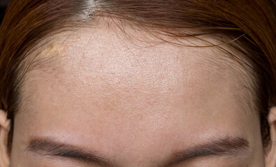 Oily skin of wide forehead of Asian adult young woman. - obrazy, fototapety, plakaty