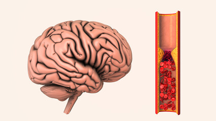 Cerebrovascular disease is an ischemic stroke