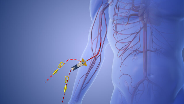 Medical concept of Combining aesthetics and feasibility in PICC port placement	

