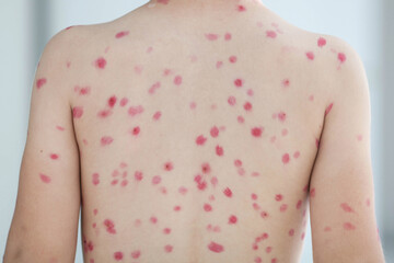 Treatment of ulcers from chickenpox, chickenpox with a healing cream on the skin of a child....